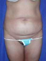 before abdominoplasty