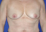 before breast augmentation