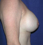 after breast augmentation
