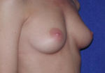 before breast augmentation