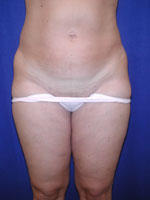before liposuction