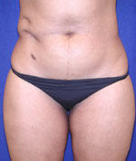 after liposuction