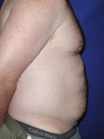 before male liposuction 