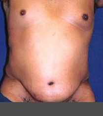 before male liposuction 