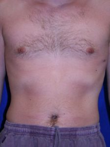 after male liposuction