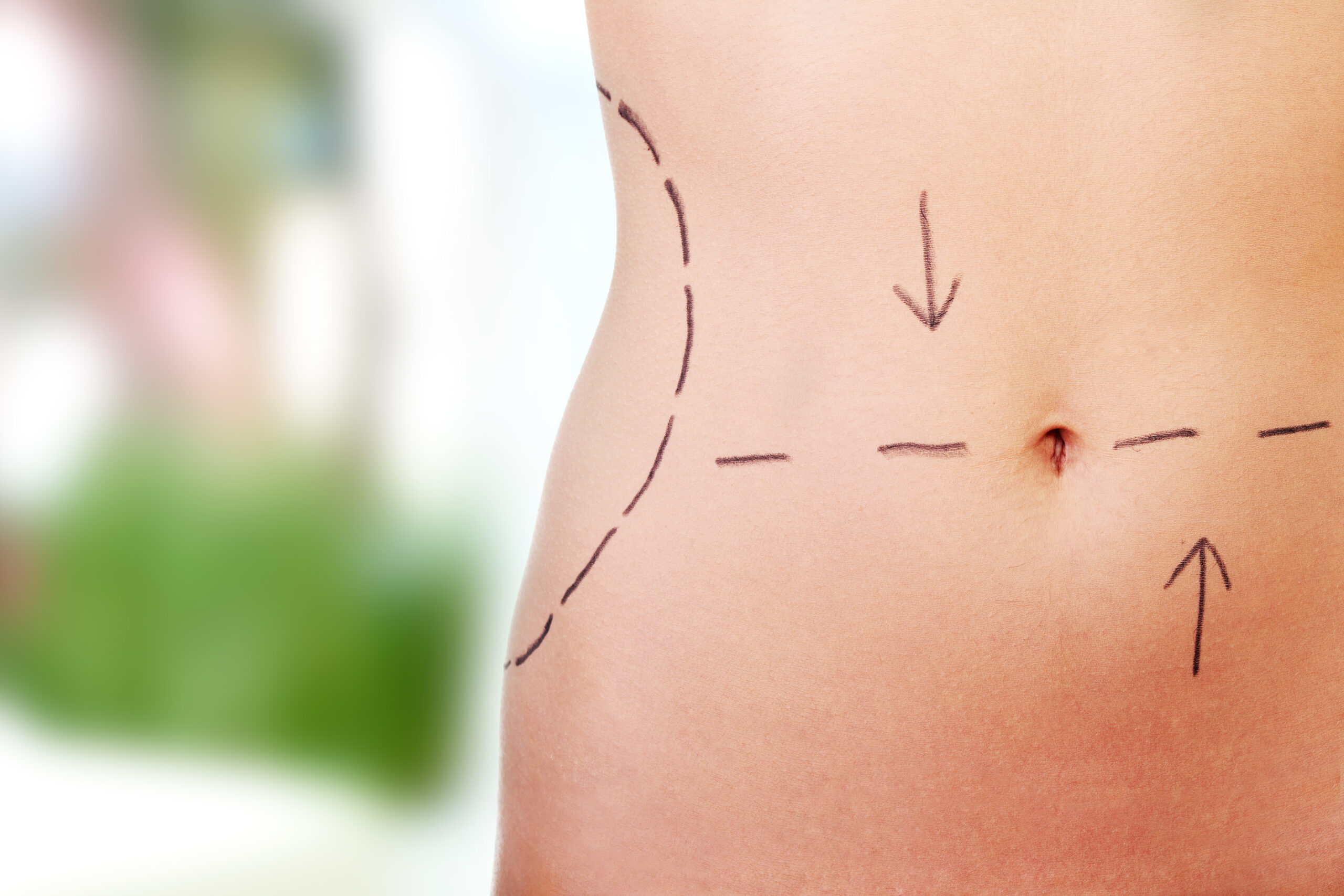 woman's waist with pre-surgical lines