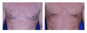 before and after gynecomastia