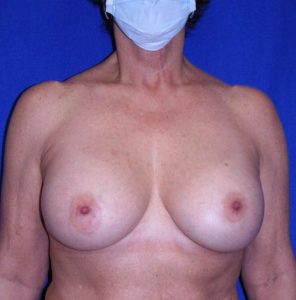 woman after breast augmentation