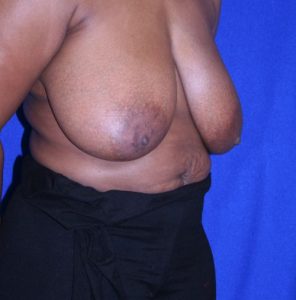 woman before breast reduction