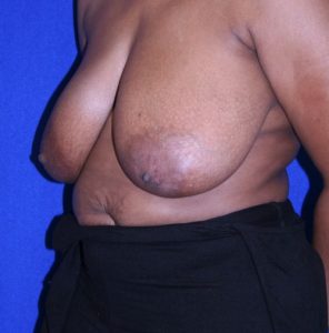 woman before breast reduction