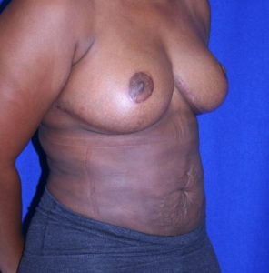 woman after breast reduction