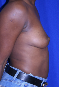 Patient before breast augmentation