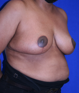 breast after surgery