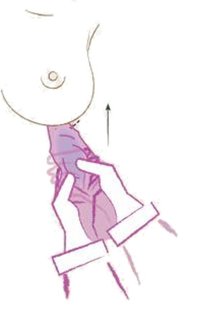 Illustration of the breast implant being placed into the prepared pocket