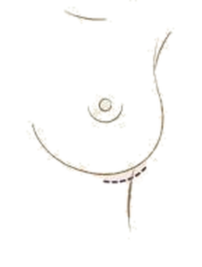 Illustration of the small incision in the inframammary fold beneath the breast