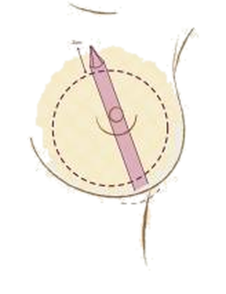 Illustration of the Motiva Channel Separator creating a tunnel without cutting the tissue